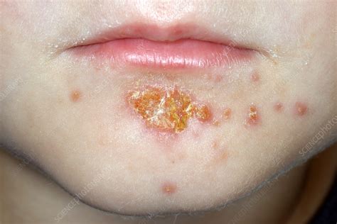 Impetigo Lips Images | Sitelip.org