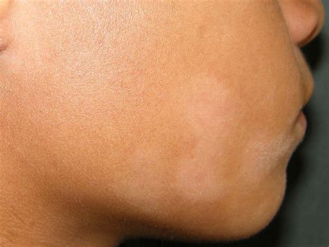 White patches/spots on the face of your childPityriasis Alba vs VitiligoHOME REMEDIES