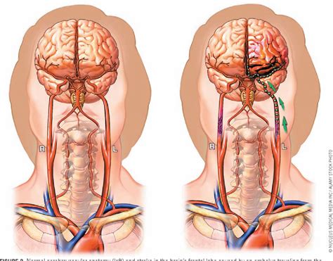 Figure 2 from Spontaneous carotid artery dissection. - Semantic Scholar