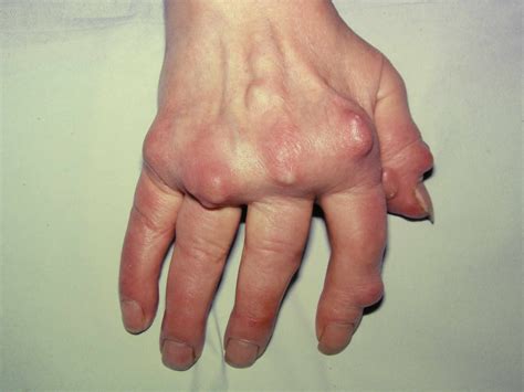 Tophaceous Gout: Symptoms, Treatment, Prevention