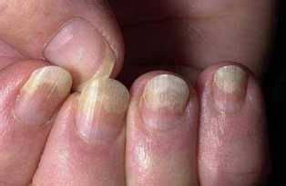 10 Diseases You Should Know That Show Up In Your Nails - Health - Nigeria | Fingernail health ...