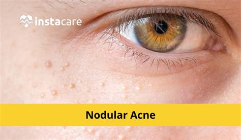 Nodular Acne: Causes, Symptoms, Treatment and More