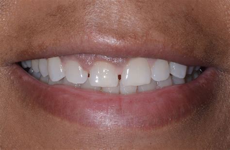 Bioclear Diastema Closure - Bioclear Clinic