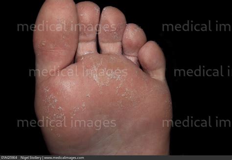 STOCK IMAGE, juvenile plantar dermatosis on the foot of an eleven year old female patient ...