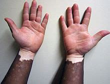 Vitiligo - Vitiligo - other.wiki