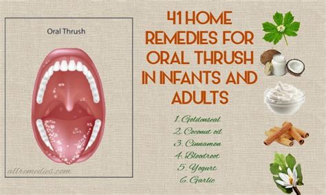 Top 41 Home Remedies for Oral Thrush: Causes, Symptoms, Prevention