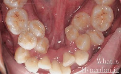 What Is Hyperdontia: 7 Effective Treatments For Excess Teeth