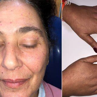 A, Spider‐like telangiectasia were mainly located on the face. B,... | Download Scientific Diagram