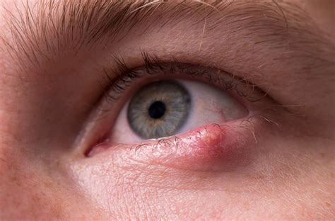 What Is a Stye? Plus, Eye Stye Causes and How to Get Rid of a Stye
