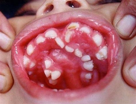 Hyperdontia - MEDizzy