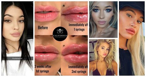 What Age Do You Need To Be Get Your Lips Done | Lipstutorial.org