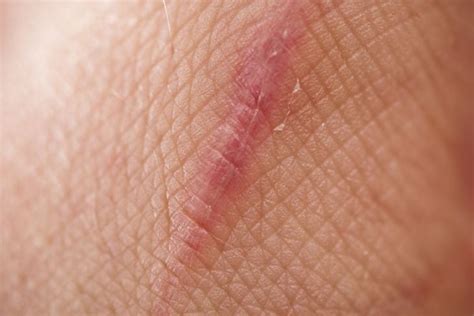 Types of Scar Tissue and How to Prevent Them - Facty Health