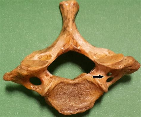 Double foramen transversarium. | Download Scientific Diagram