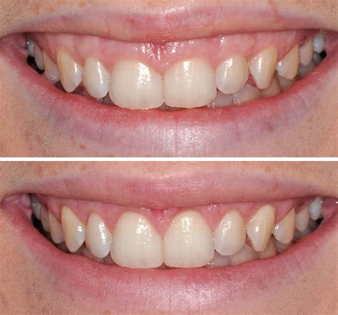 Gum Lift | Dental Esthetics Center