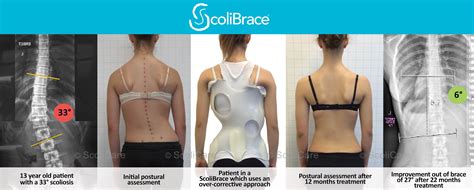 Scoliosis Treatment - Foundation Spine and Posture