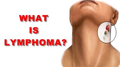 What is Lymphoma? Cancer Of The Lymph System Non Hodgkins Lymph Node Cancer - YouTube