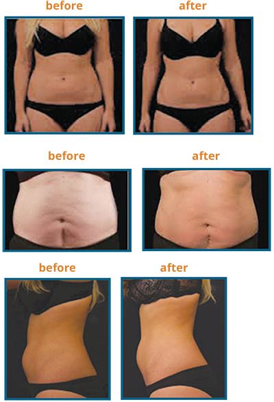 Fat Removal Los Angeles