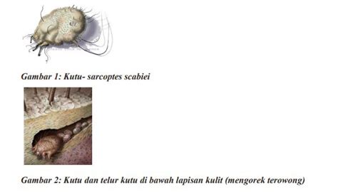 Cara Atasi Penyakit Kudis Buta