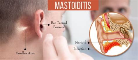 Mastoiditis is majorly as a result of an infection in the middle ear ...