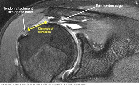 MRI of torn rotator cuff - Mayo Clinic