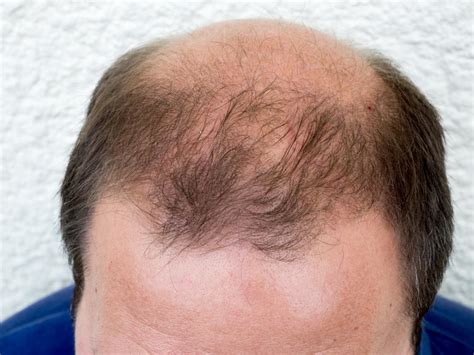 Propecia phase III 5 year hair loss results - Regrowth. Your Source Of Hair News