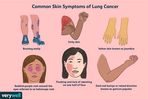 Lung Cancer Symptoms on the Skin to Watch For