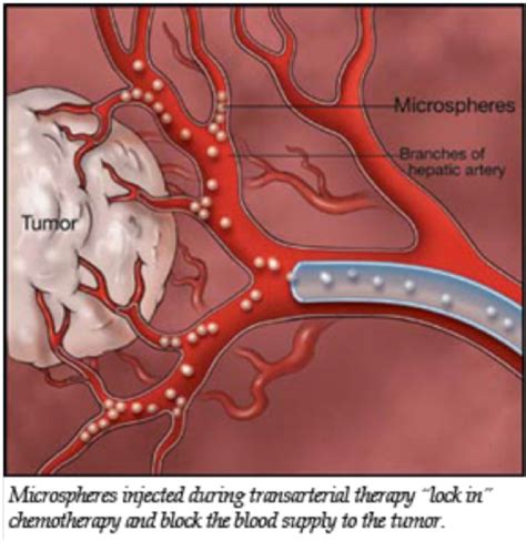 Liver Tumors using TACE | ERA Billings