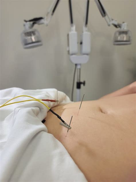 Electro-Acupuncture for Pain Relief - Advanced Women's Health Clinics