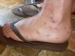 Sand Flea Bites: Photos, Diagnosis, Causes, Risk & Treatments