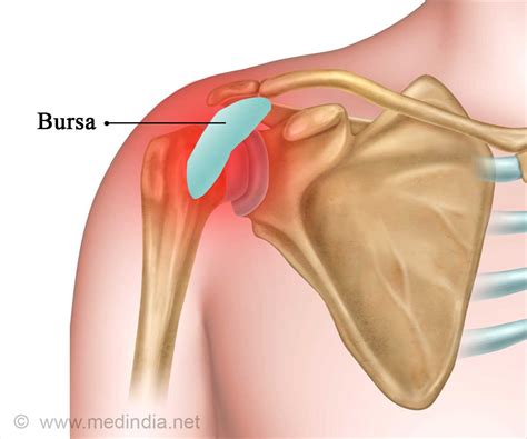 Subacromial Bursitis Presentation And Treatment Bone And, 42% OFF