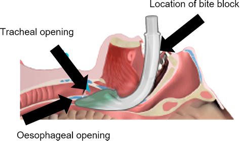 Supraglottic Airway (SGA)