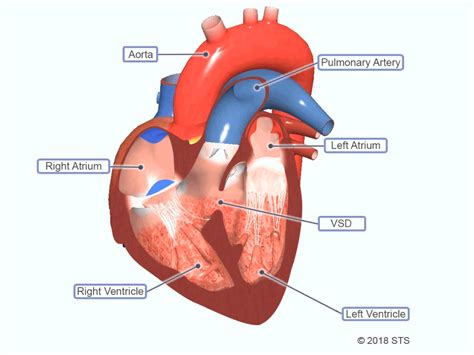 Ventricular septal defects (VSDs) are one of the most common congenital heart defects. A ...