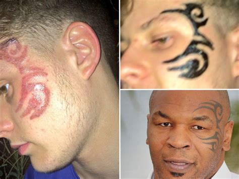 Mike Tyson Face Tattoo Removed