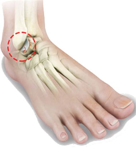 Ankle Arthritis and Your Options • Southwest Florida's Health and Wellness Magazine