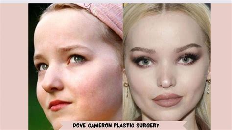 Dove Cameron Plastic Surgery, How Many Surgeries Does Dove Cameron Have ...