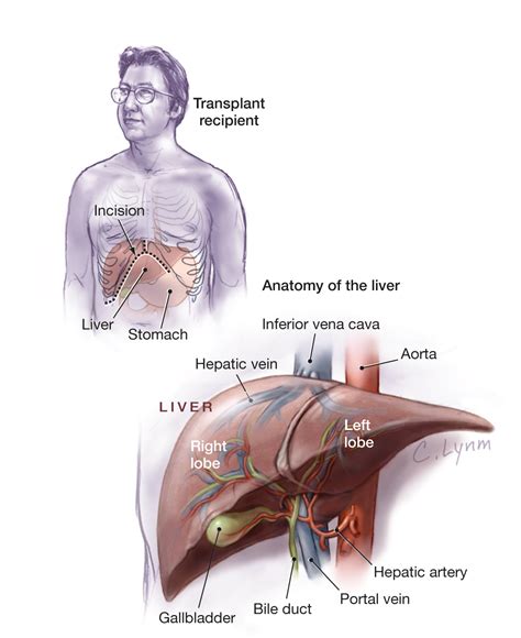 Liver Transplantation | Gastrointestinal Surgery | JAMA | JAMA Network