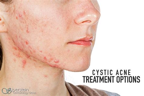 Cystic Acne Treatment | vlr.eng.br