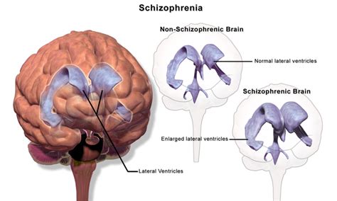 Scientists Discover Brain Area Which Can Be Targeted For Treatment In Patients With ...