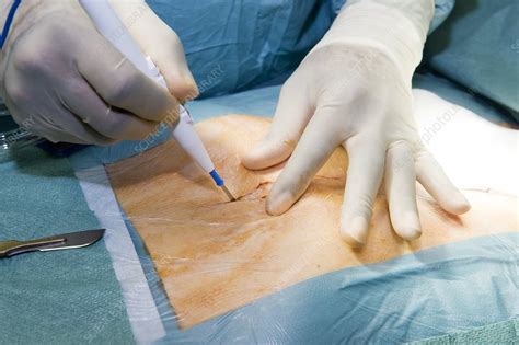 Aorta surgery - Stock Image - C005/7760 - Science Photo Library