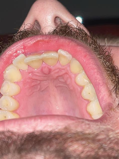 how to treat sore roof of mouth 1