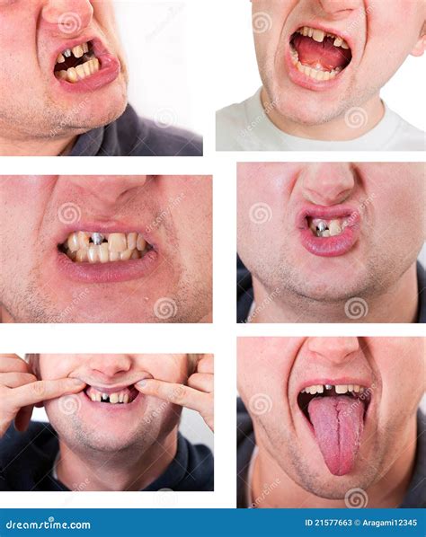 how to fix a broken tooth at home 3