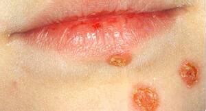 Impetigo: How to Protect Your Kids From The Contagious Skin Infection This Summer