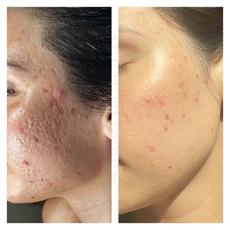Acne Scaring. Jet Plasma. Reduce Acne Scars. Smooth Skin.