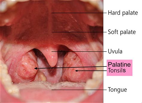 tonsillectomy indications recovery time cost  complications