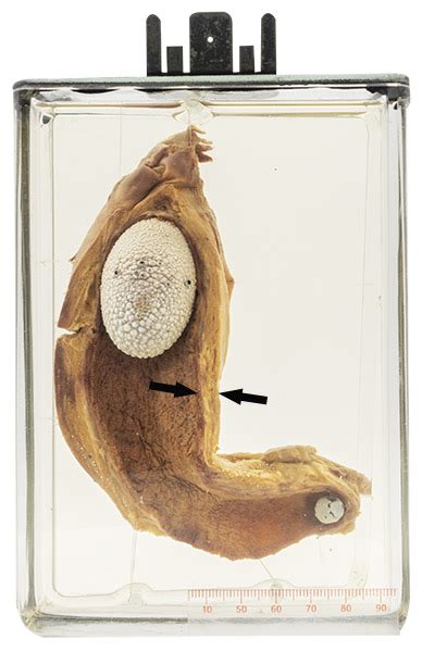 gallbladder stones maude abbott medical museum mcgill university