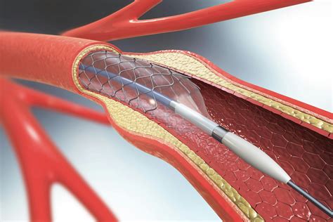 FDA Recalls Medtronic Atherectomy Device | MedTruth - Prescription Drug