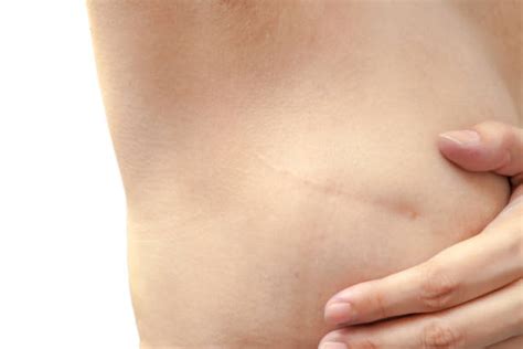 50+ Mastectomy Scars Stock Photos, Pictures & Royalty-Free Images - iStock