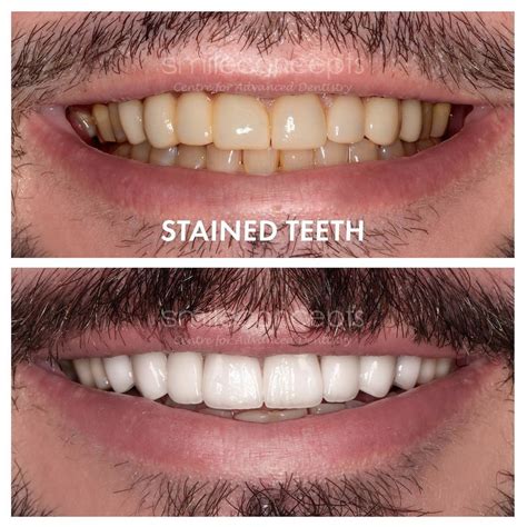 how long to veneers last