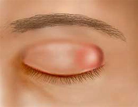 Chalazion & Chalazia: Causes & Treatment Options