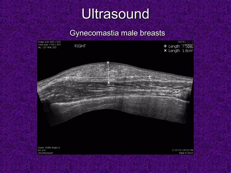 Radiological examination of breast & Genital organs | PPT